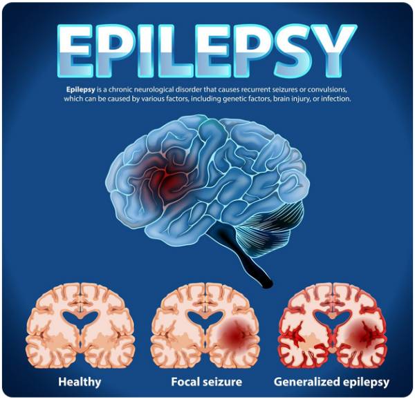 हरियाणा में मिर्गी सर्जरी