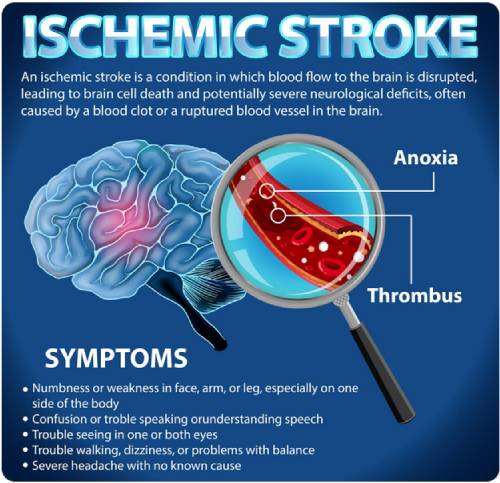 हरियाणा में ब्रेन स्ट्रोक विशेषज्ञ