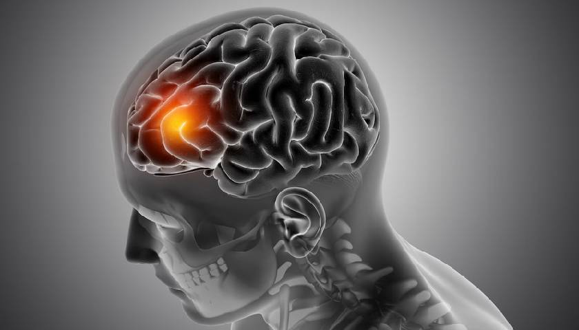 नारनौल में ब्रेन स्ट्रोक का इलाज