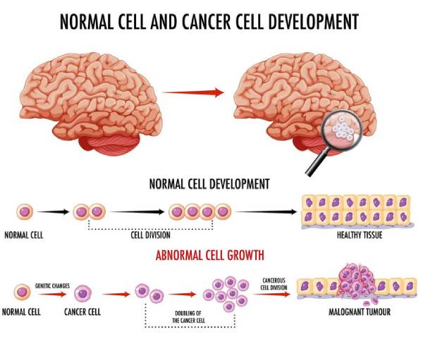 नारनौल में ब्रेन ट्यूमर क्लिनिक