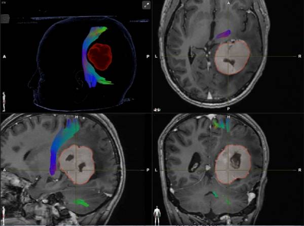 हरियाणा में ब्रेन ट्यूमर सर्जरी