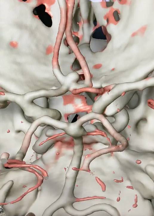 नारनौल में मस्तिष्क धमनीविस्फार डॉक्टर