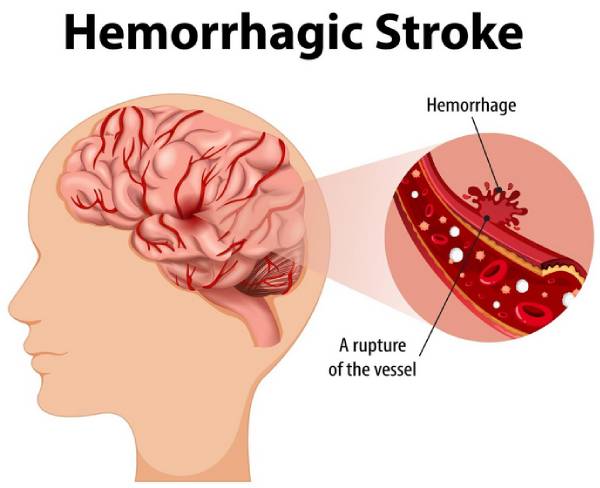 हरियाणा में ब्रेन हेमरेज सर्जन