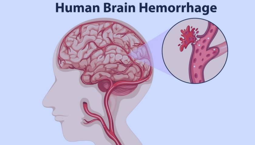 हरियाणा में ब्रेन हेमरेज का इलाज