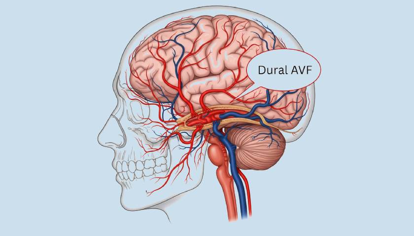 नारनौल में धमनीशिरापरक फिस्टुला उपचार