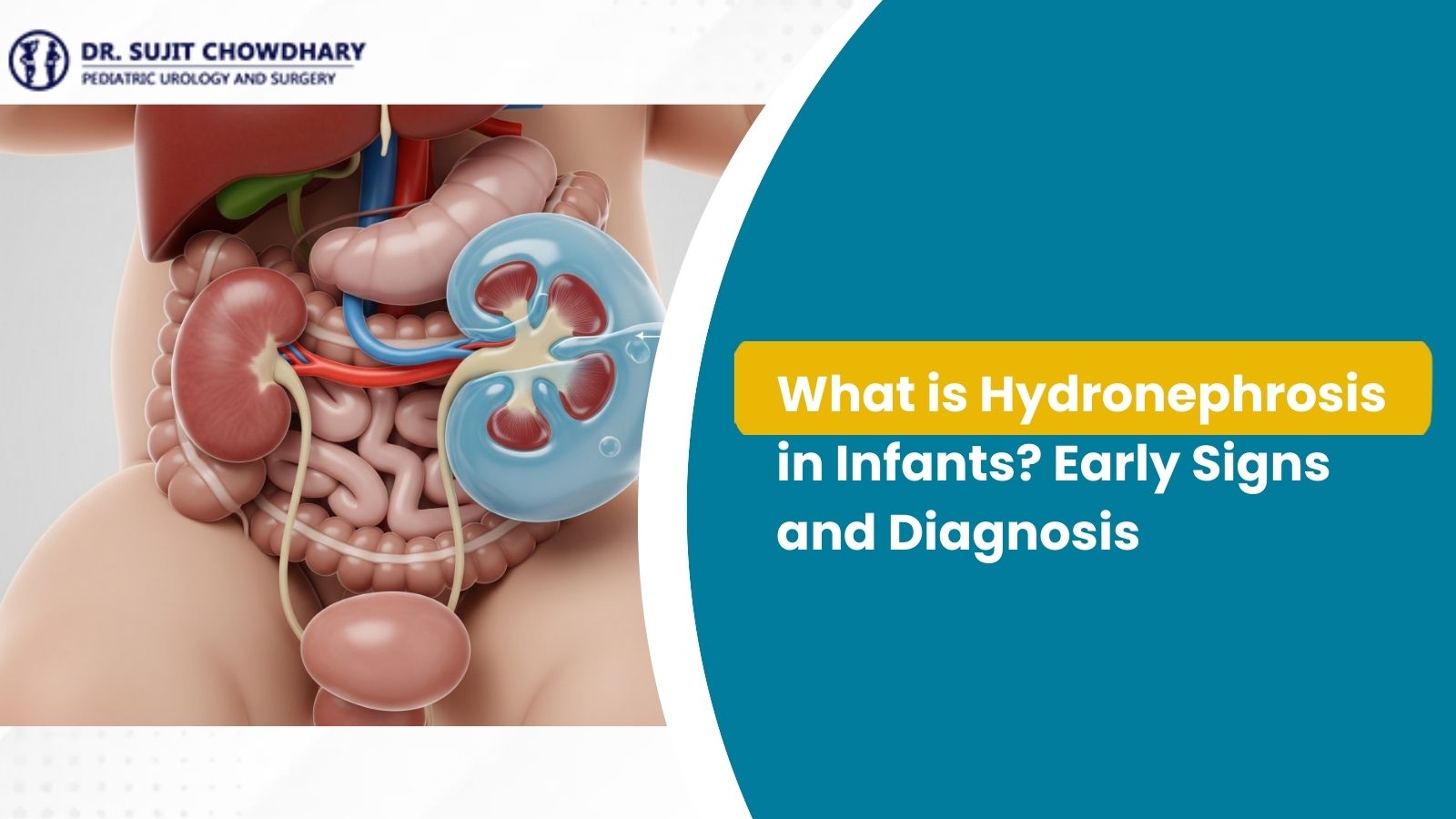 What is Hydronephrosis in Infants