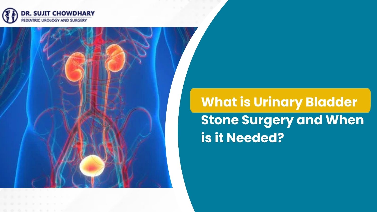 Urinary Bladder Stone Surgery