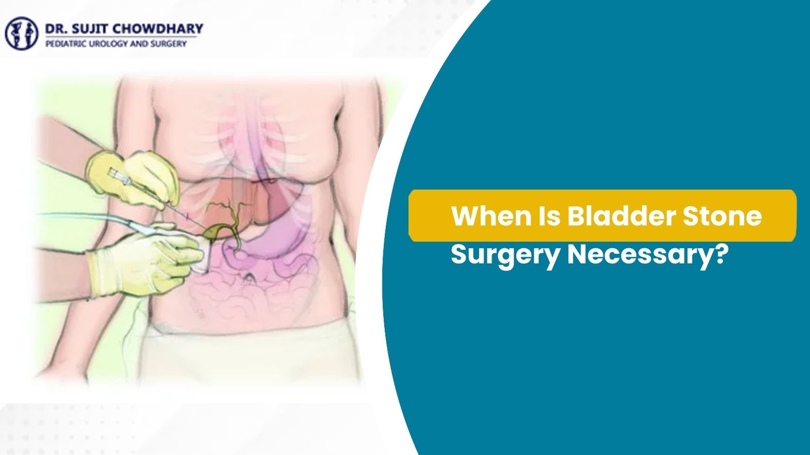 Bladder Stone Surgery