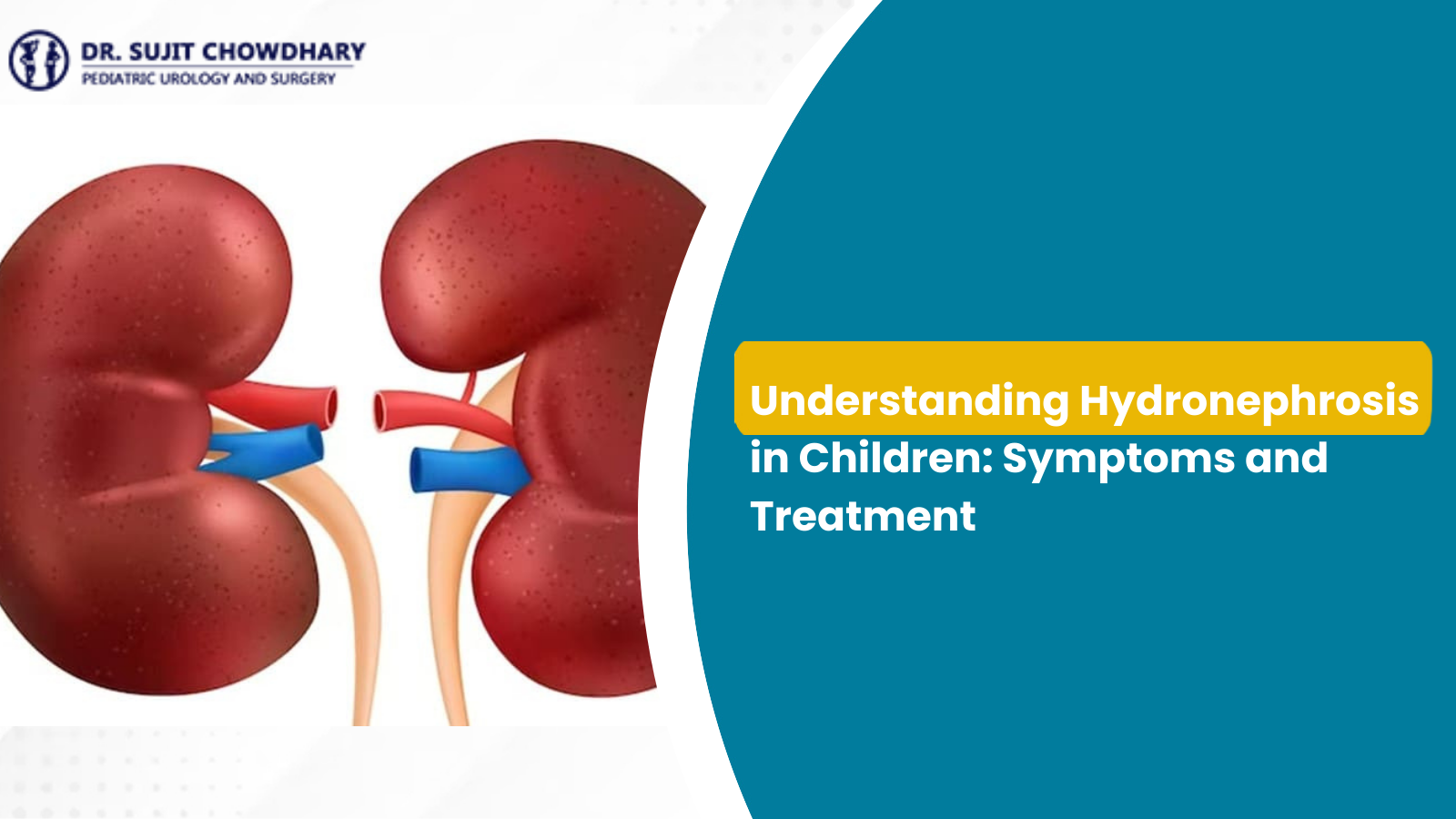 Гидронефроз