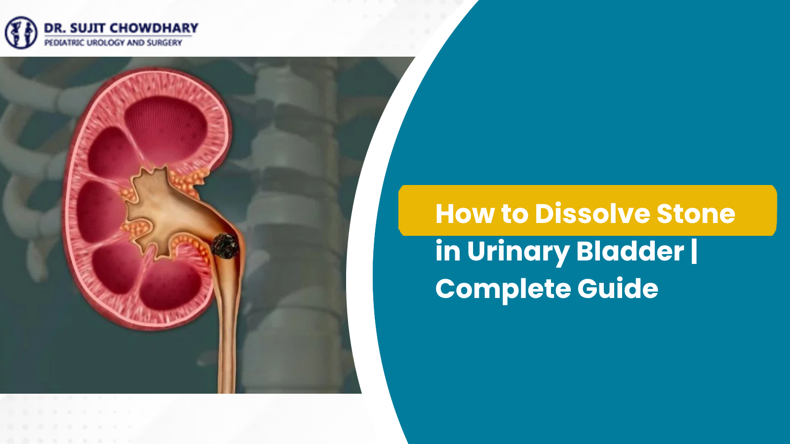 How to Dissolve Stone in Urinary Bladder