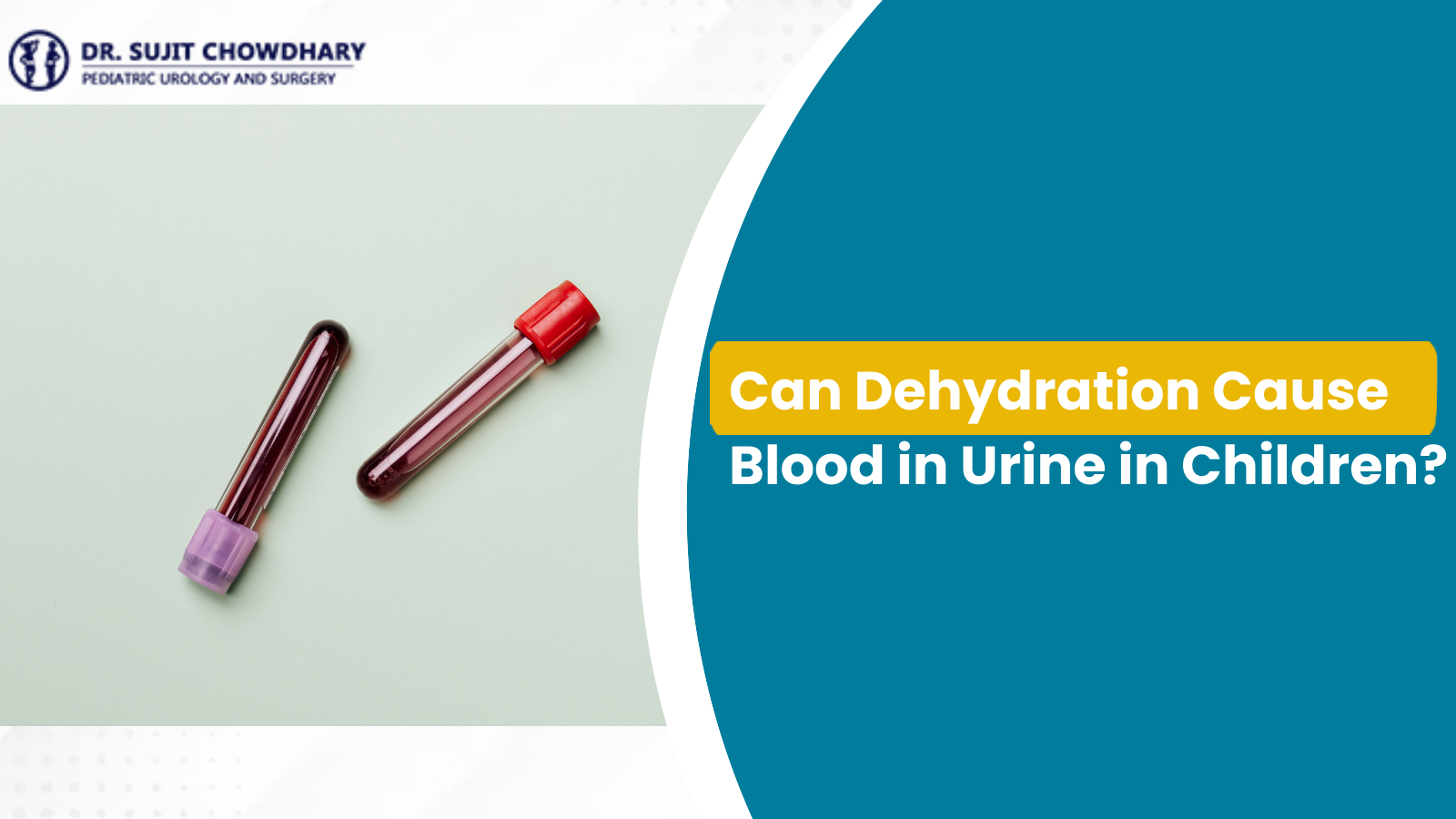 ডিহাইড্রেশন কি শিশুদের মধ্যে প্রস্রাবে রক্ত সৃষ্টি করতে পারে যা হেমাটুরিয়া নির্ণয়ের প্রতিনিধিত্বকারী রক্তের নমুনা টেস্ট টিউবগুলির সাথে দেখানো হয়েছে