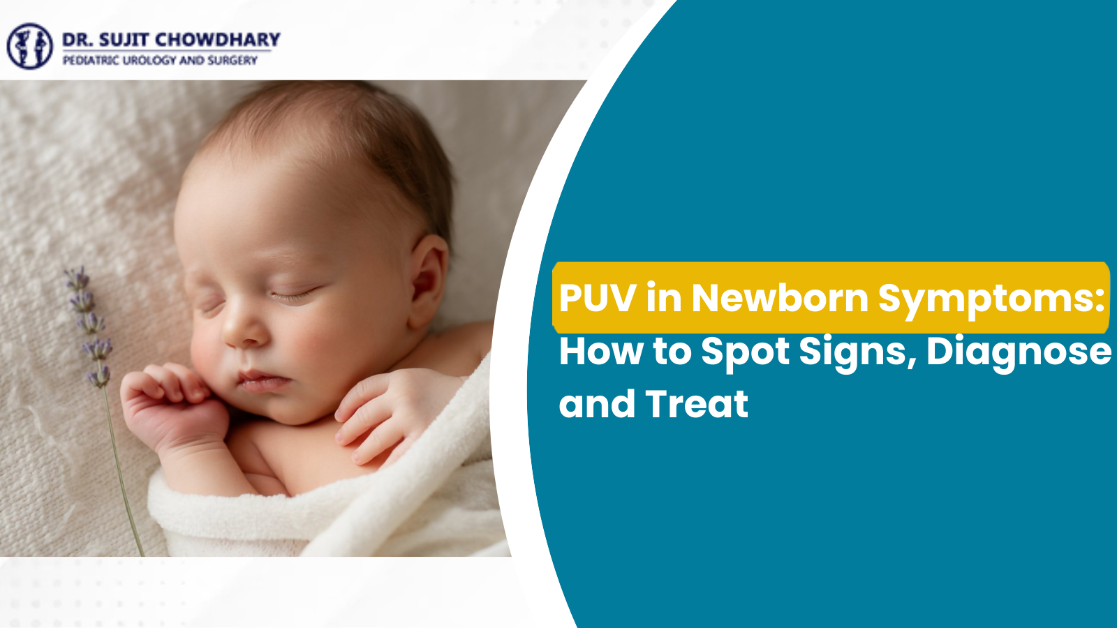 Sleeping newborn baby representing PUV in newborn symptoms, highlighting early signs, diagnosis, and treatment.