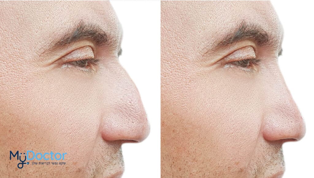 injections-lp-nose - MyDoctor