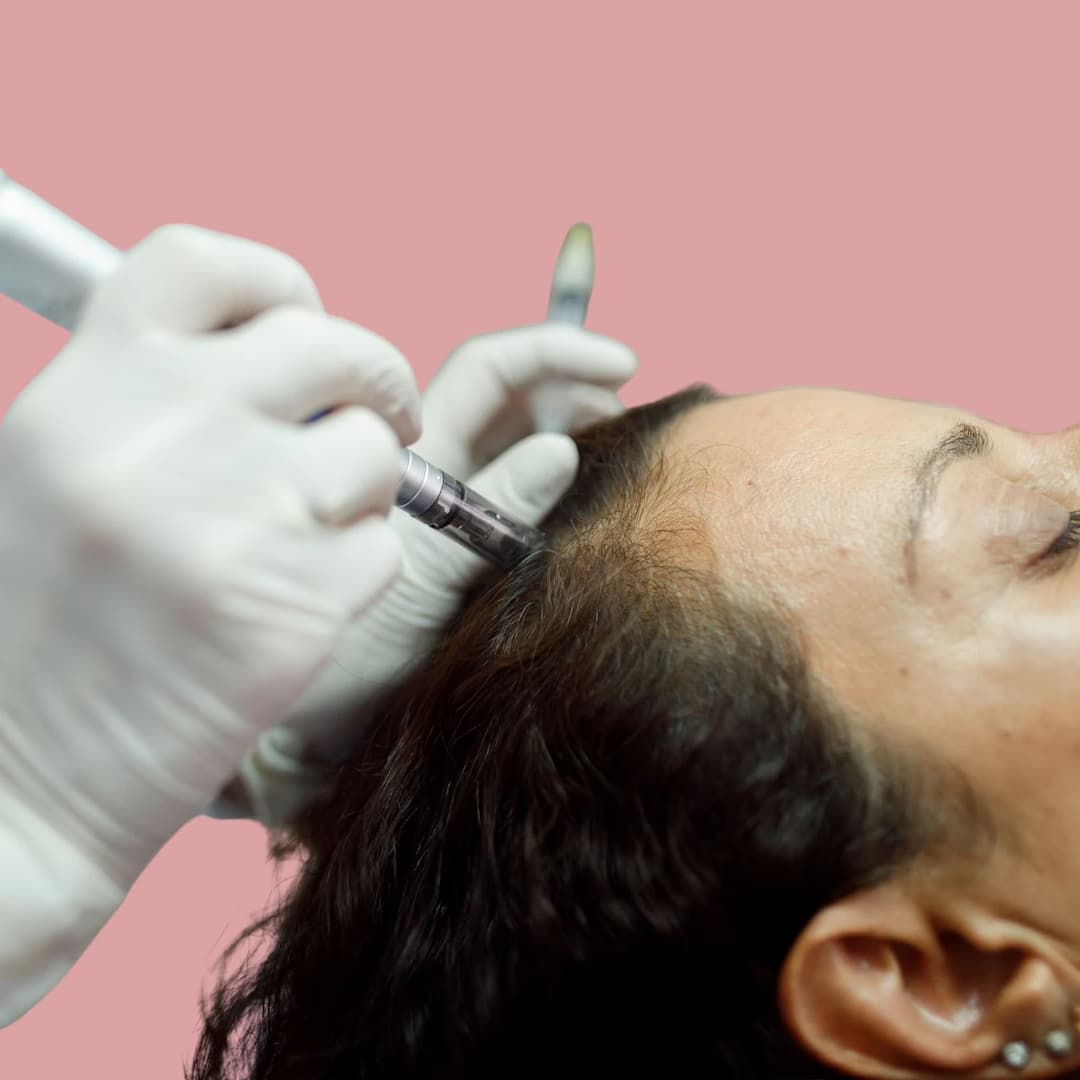Haargroei Microneedling