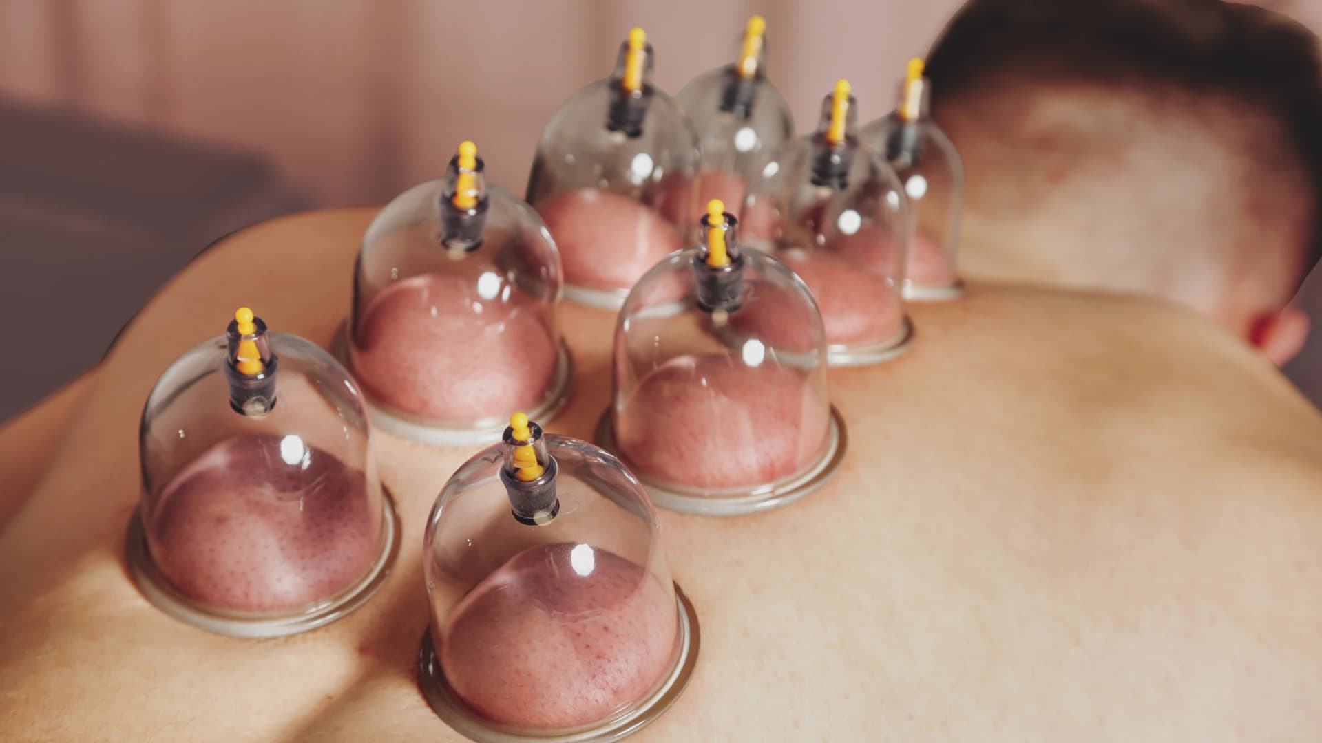 Cupping Massage in Nijmegen: Diepe Spierontspanning & Detox | SkinSymphony