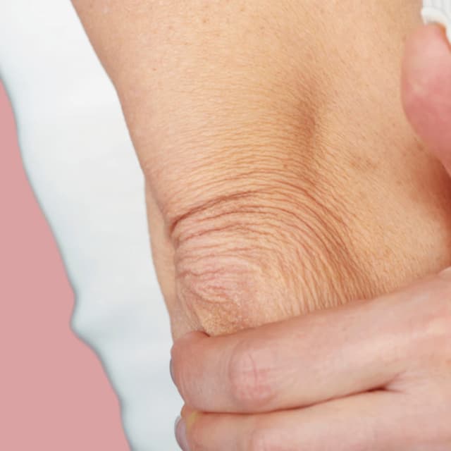 Zone 5 : Elbows CO2 Laser Skin Resurfacing