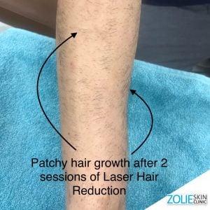 Laser-Hair-Reduction-patchy-hair-ZolieSkinClinic