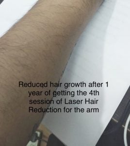 Laser-Hair-Reduction-hair-growth-after-one-year-ZolieSkinClinic