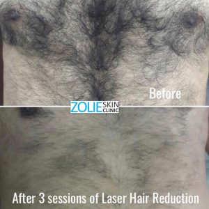 Hair-removal-treatment-before-after-Zolieskinclinic