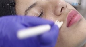 Chemical-peel-Acne-Treatment