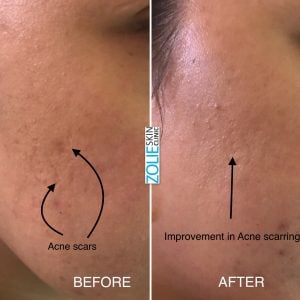 Acne-Scar-Treatment-Before-After