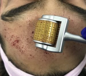 Micro-Needling-RF