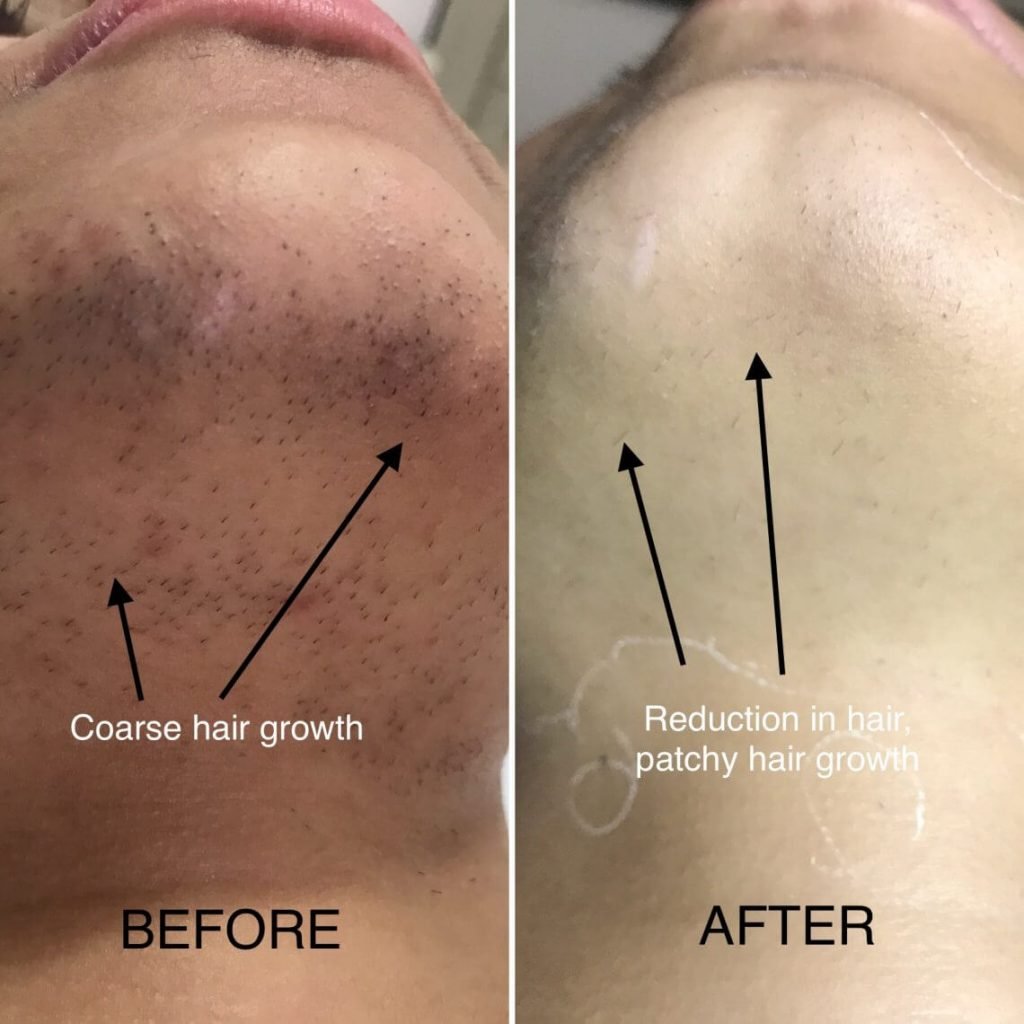 before and after photos of laser hair reduction