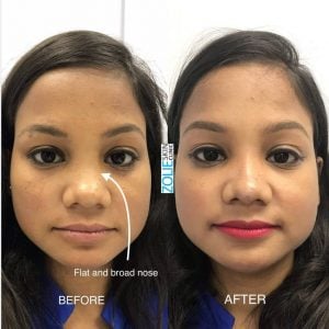 before and after pictures of nose job rhinoplasty