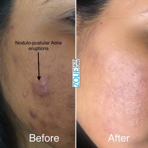 How-to-Reduce-and-Treat-Acne-Zolieskinclinic 