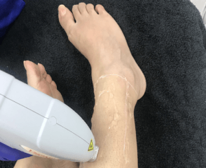 laser hair reduction on leg myths 