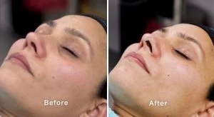 Clinicalfacialbeforeafter