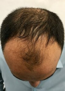 Hairtransplantion