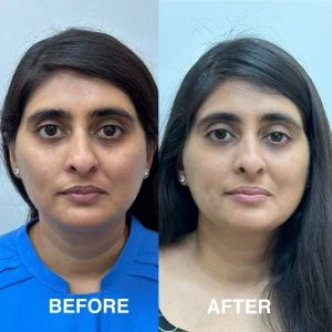 NCTF-treatment-in-Delhi-before-after-300x300