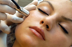 microdermabrasion2