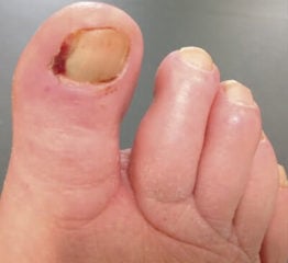nail_avulsion