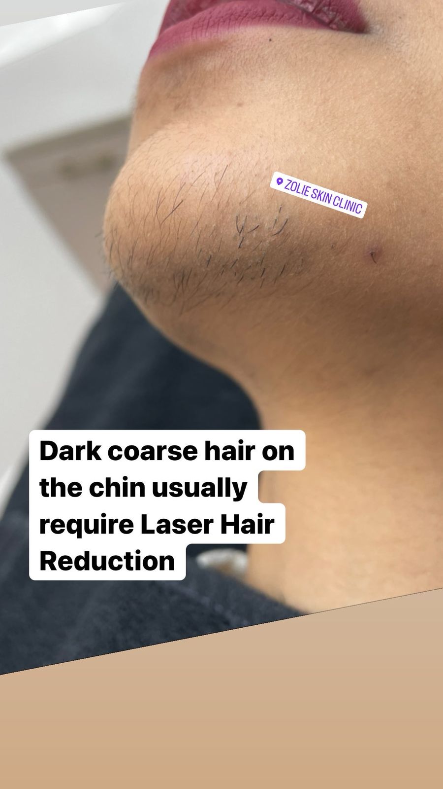 Laser_Hair_Reduction_4 Laser Hair Reduction Procedure