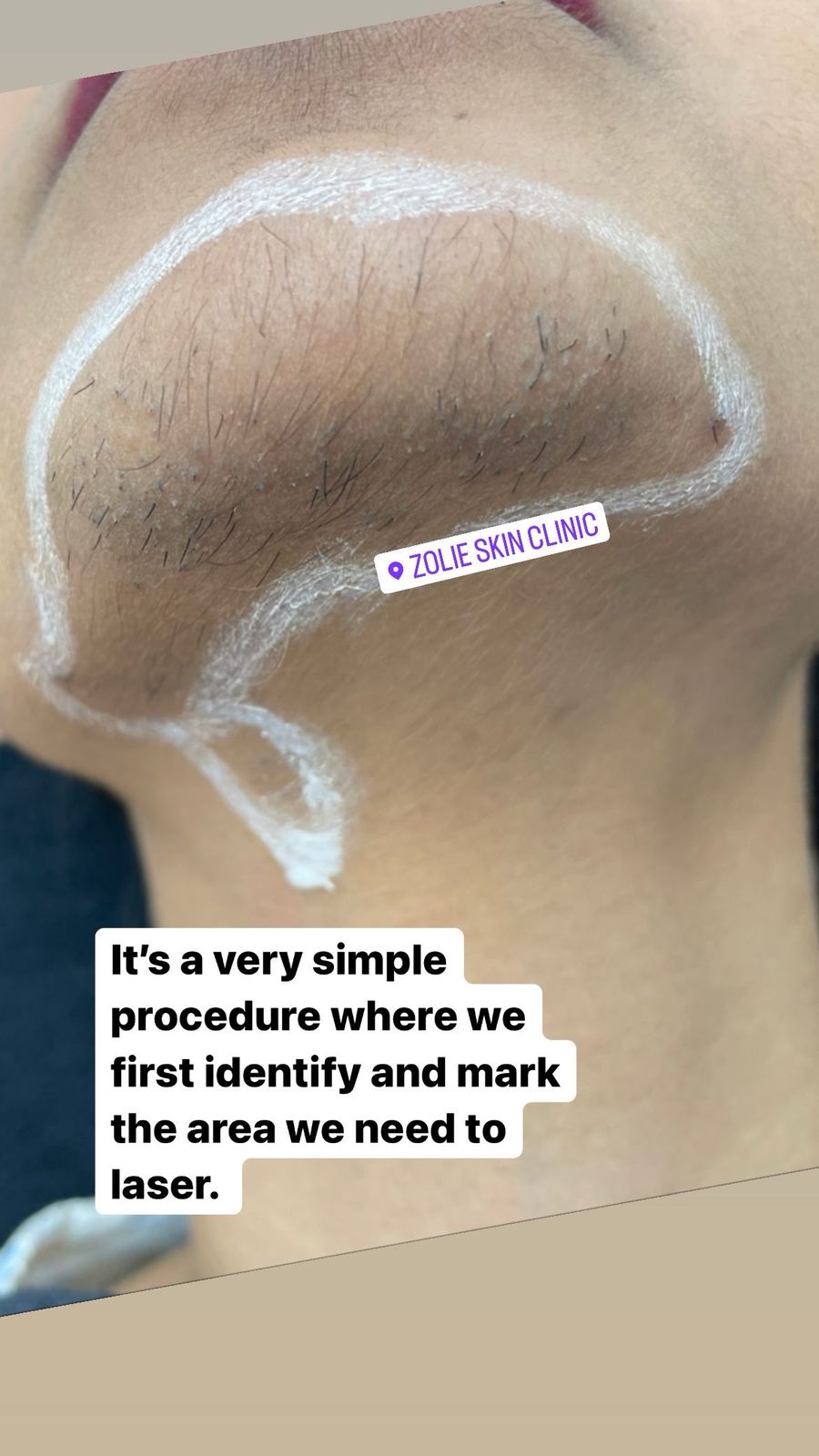 Laser_Hair_Reduction_5